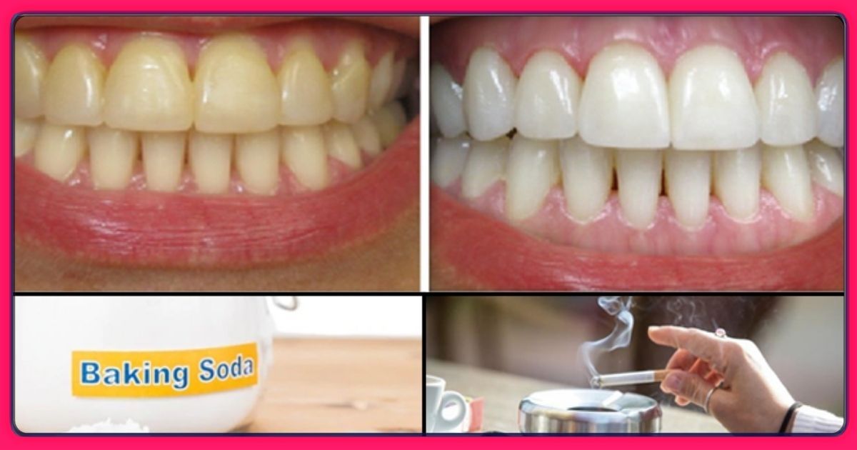 काय आपले पण दात पिवळे किंवा लाल पडले आहेत…तर आजच करा हे घरगुती उपाय…काही क्षणात आपले दात हिऱ्यासारखे चमकतील