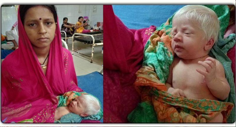 भागलपुर में अंग्रेजी बच्चे ने लिया जन्म, मुंगेर की महिला बनी मां, डॉक्टर ने कहा हजारों में एक ही होता है ऐसा